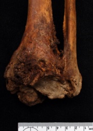 Reconsidering osteoarthritis as a skeletal indicator of age at death by Allysha P. Winburn